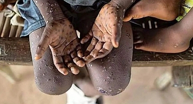 Afrika'da Maymun Çiçeği Virüsüne 