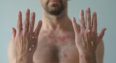 Ankara İl Sağlık Müdürlüğü'nden Maymun Çiçeği Hastalığı İddialarına Yalanlama