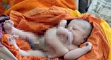 Dört Kollu ve Dört Bacaklı Bebek Doğdu: Sebep Aşılar mı, Yoksa Fetal Gelişim mi?