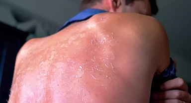 Güneş Yanıklarında Tedavi Yöntemleri