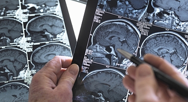 Dünya İnme Günü'nde inme farkındalığı artıyor