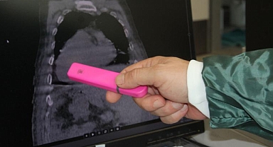 Giresun'da İlk Kez Görülen 'Giresun Sendromu' Tıp Literatürüne Girdi