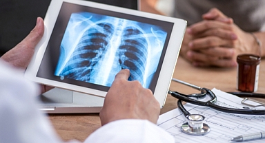 Sigaranın gölgesinde büyüyen bir tehdit: Akciğer kanseri