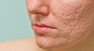 Dünyada ilk akne aşısı geliştiriliyor: Akneye son verebilir mi?